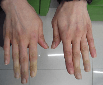 raynaud-fenomeni