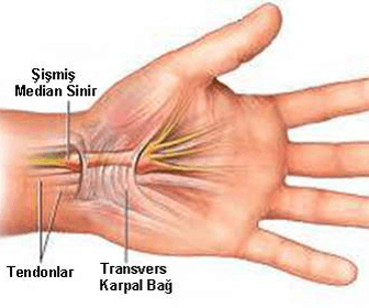 karpal-tuneli-hastaligi